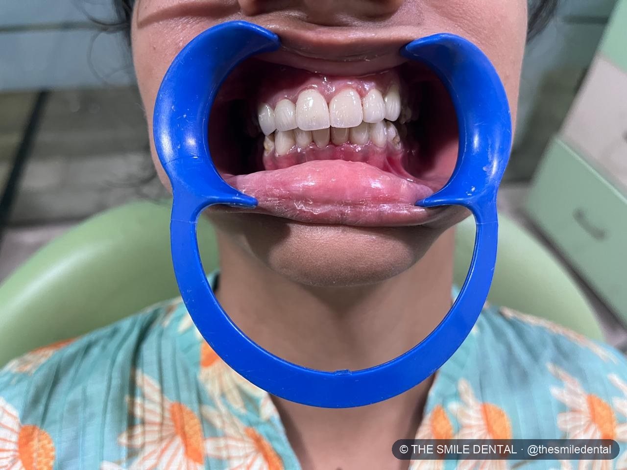 After treatment