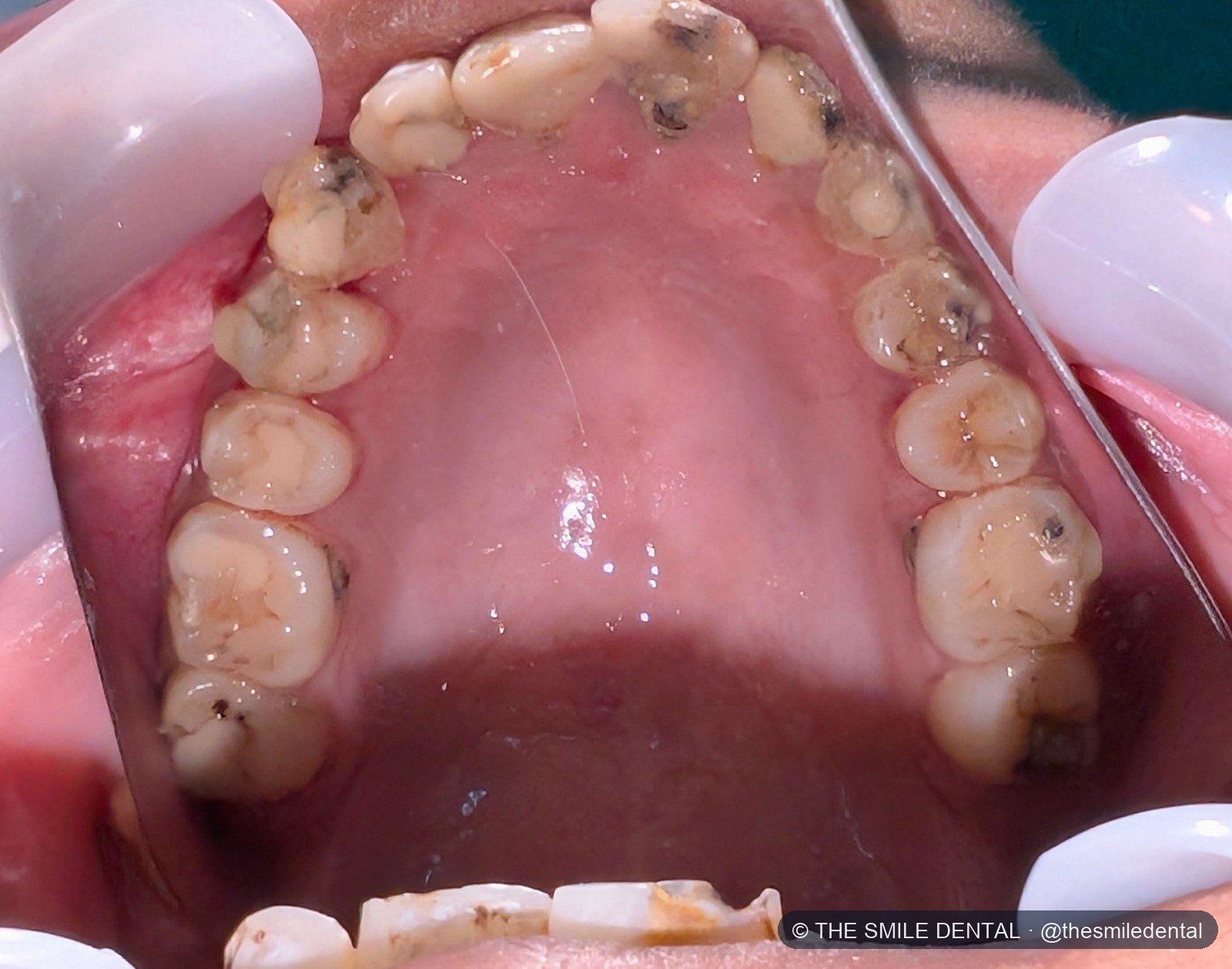 Upper teeth before treatment