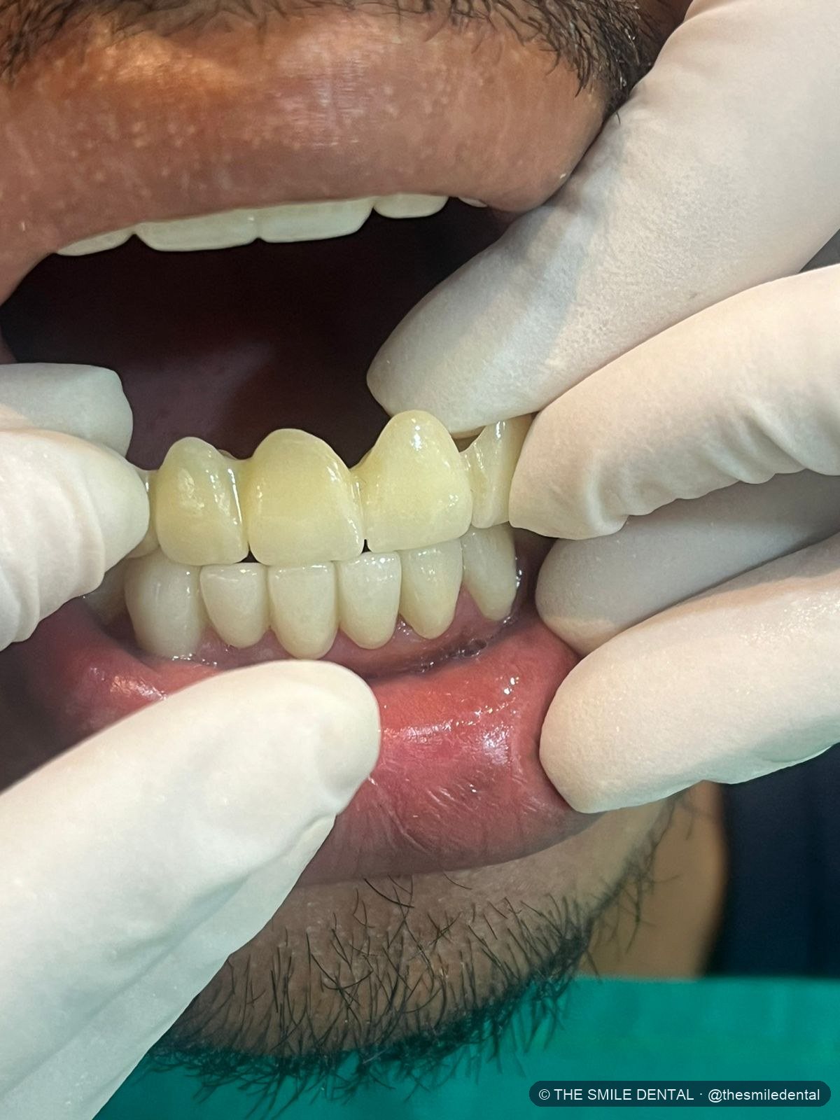 Shade guide held next to the teeth