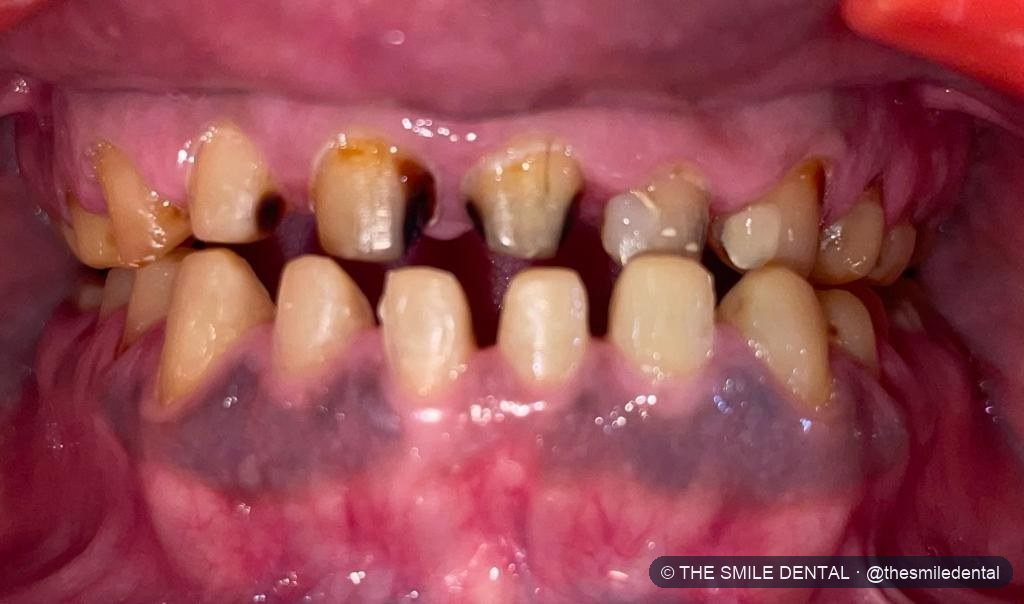 Before treatment