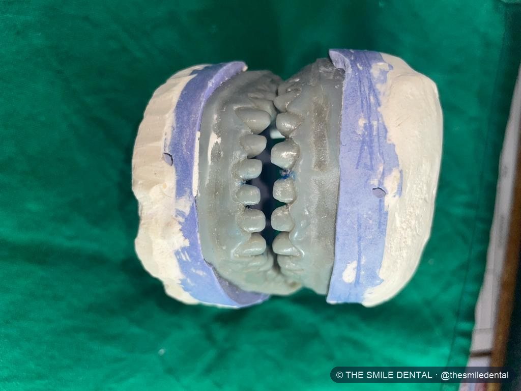 Jaw models set together