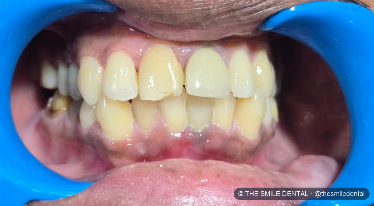 Before treatment
