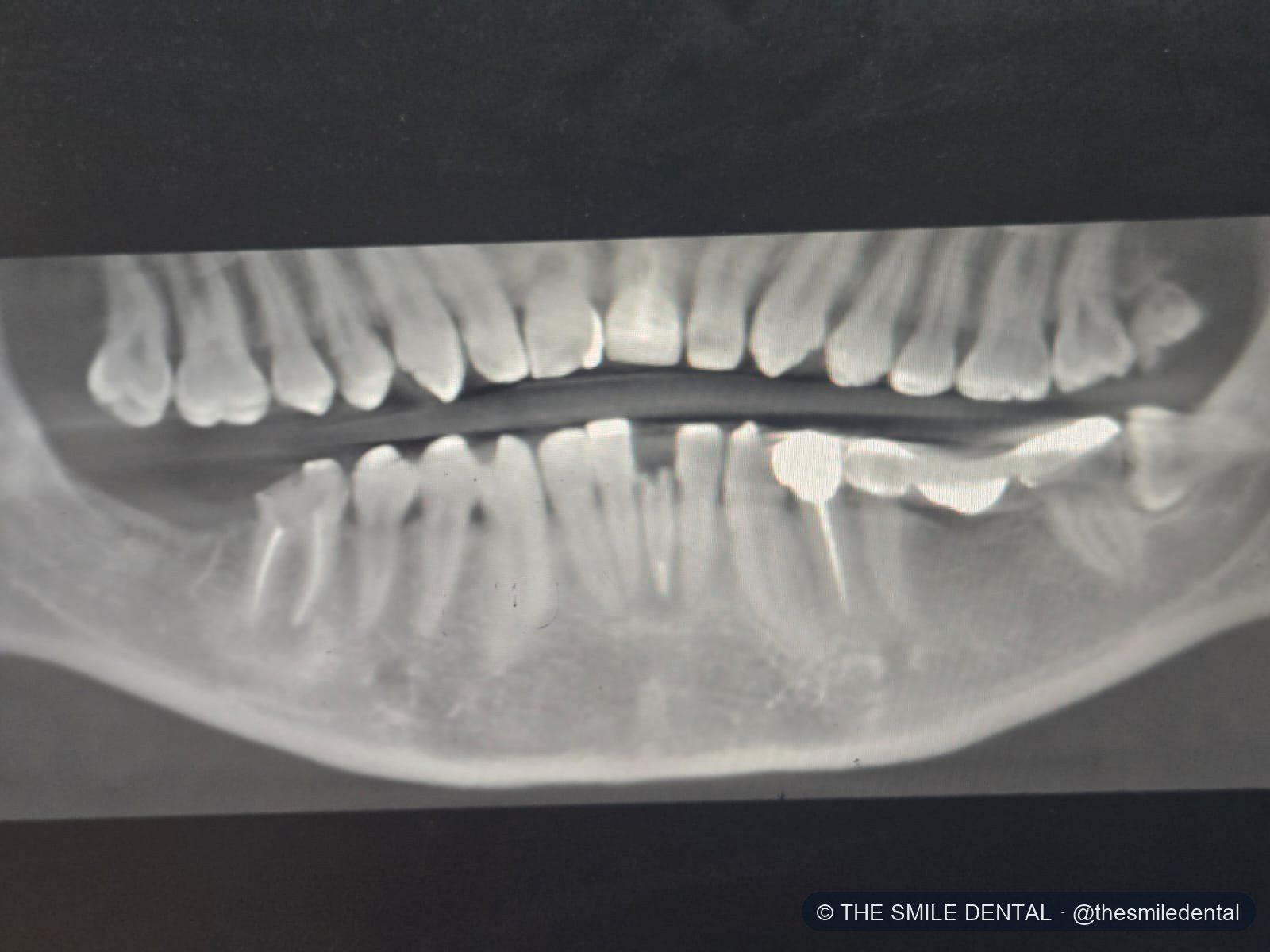 Panoramic X-ray