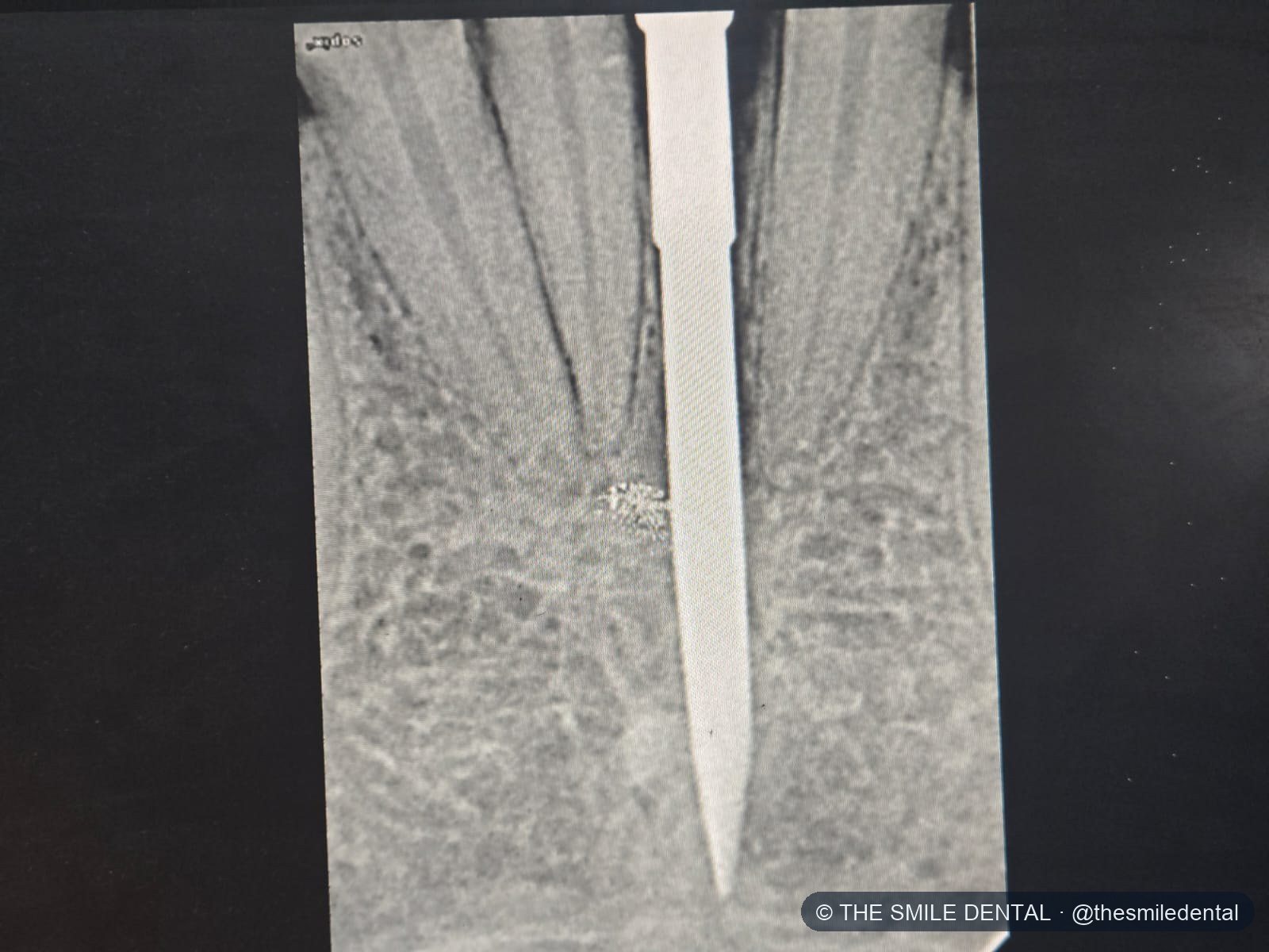 X-ray with a guide pin