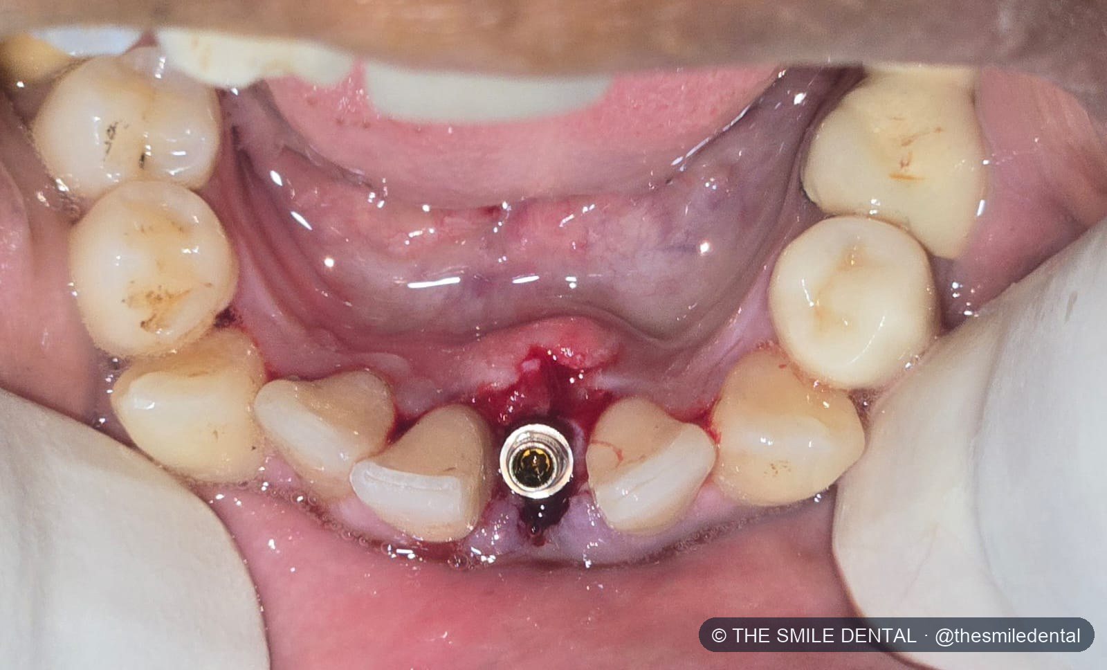 The implant in the socket during surgery