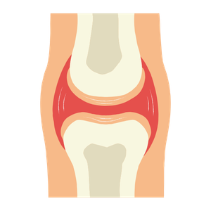 Illustration of a human knee joint showing bones and cartilage in a healthy state.
