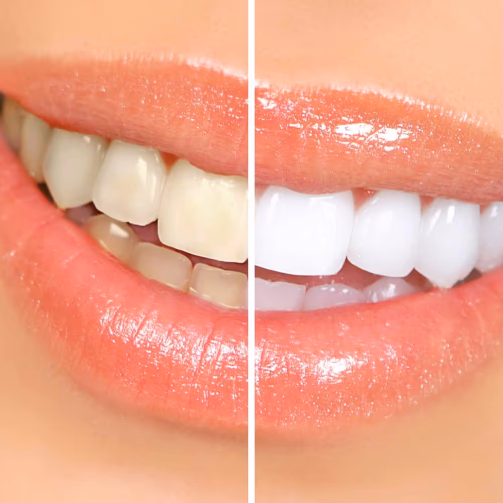 Before and after teeth whitening results