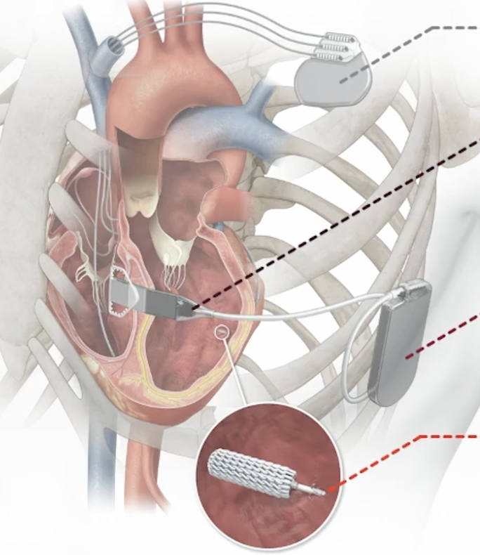Illustration of a heart with implanted pacemaker device and leads wired inside the heart chambers.