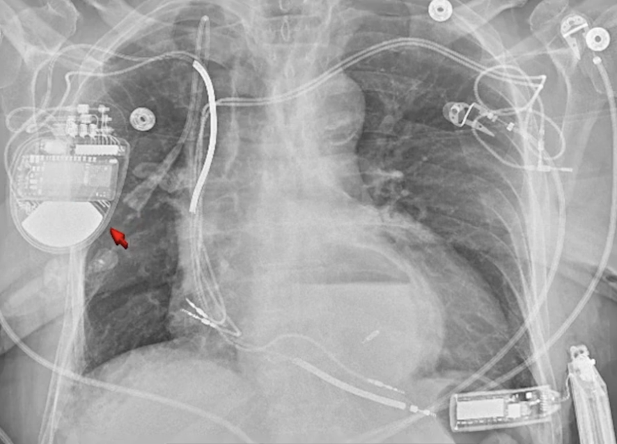 Chest X-ray showing a pacemaker and multiple electrode wires in the thoracic area.