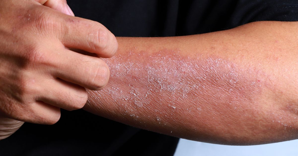 Person with eczema on arm experiencing skin inflammation