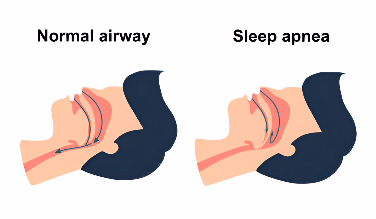 Side view illustration comparing a normal airway with sleep apnea, showing open airway in normal breathing and blocked airway due to collapsed soft tissue during sleep apnea.
