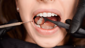 Close-up of a dental checkup showing a patient's open mouth with a dental mirror and explorer being used by a gloved dentist.