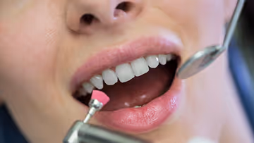 Close-up of a person receiving dental cleaning with a rotating pink polishing tool and a dental mirror near the open mouth.