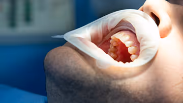 Close-up of a healthcare professional wearing a glove examining a patient's open mouth, focusing on oral cavity and teeth.