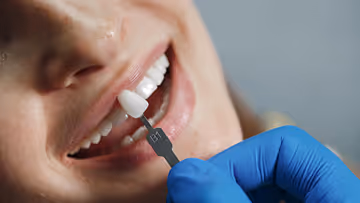 Close-up of a person with a dental professional wearing blue gloves holding a tooth shade guide next to their white teeth for color matching.