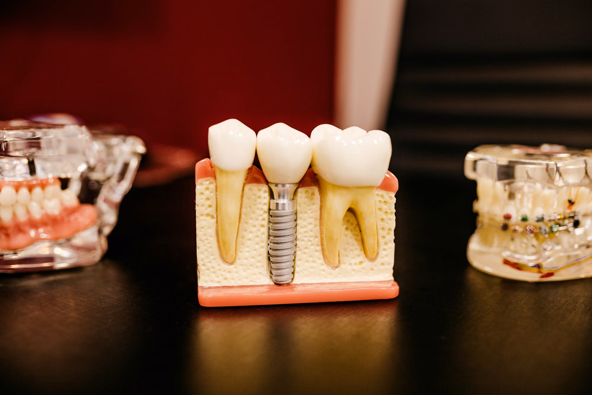 Dental implant model showing artificial tooth structure