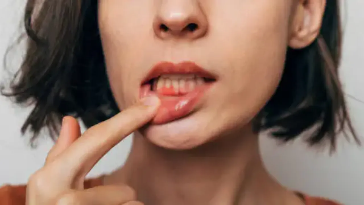 Woman pulling down her lip to reveal red, inflamed gums