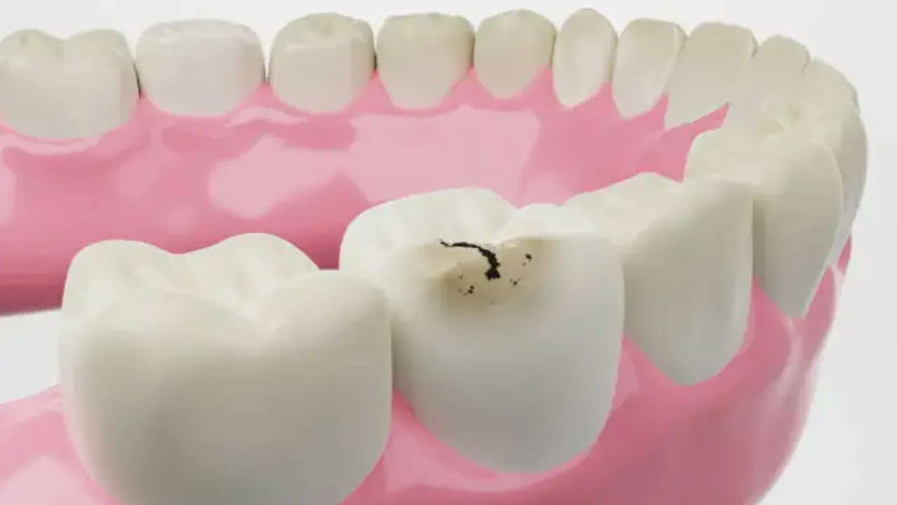 3D model of lower teeth with a cavity forming between two teeth