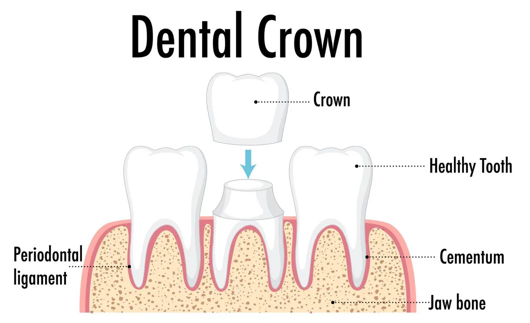 Labeled diagram of a dental crown fitted over a prepared tooth