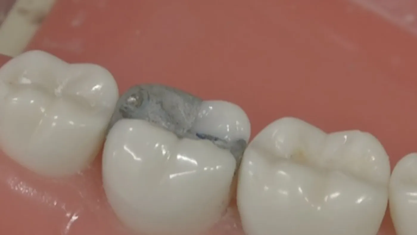Close-up of a molar restored with a filling