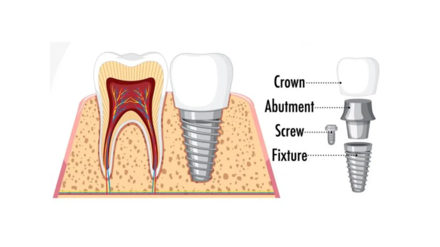 Labeled diagram of a dental implant showing the crown, abutment, screw and fixture