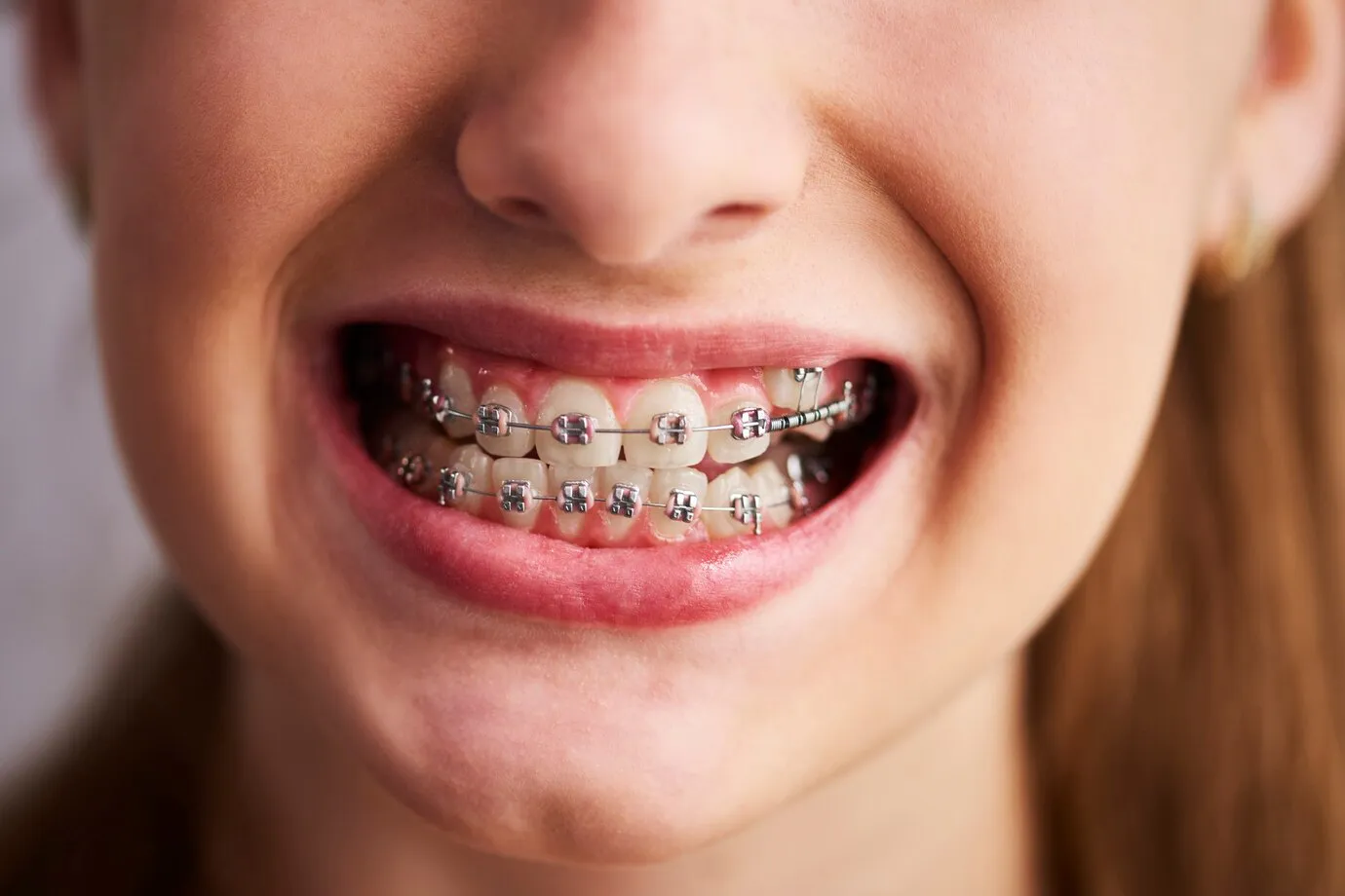 Close-up of a smile with metal braces on the upper and lower teeth