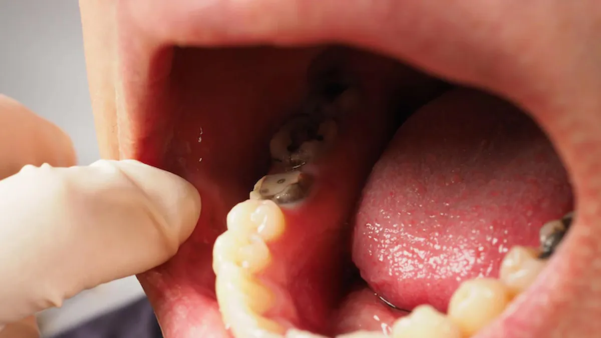Close-up of decayed and tartar-covered lower molars
