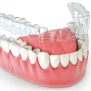 3D model of lower teeth wearing a clear aligner