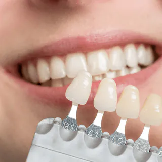 Comparison of a clear aligner and veneer shade matching