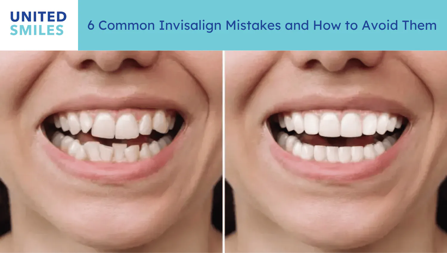 Before-and-after smile comparison for '6 common Invisalign mistakes'