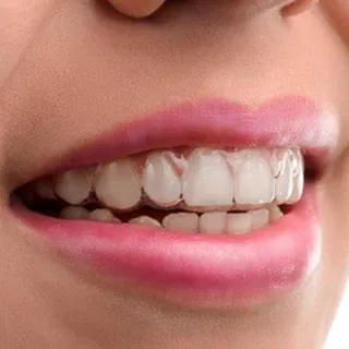 Close-up of a smile wearing a clear Invisalign aligner