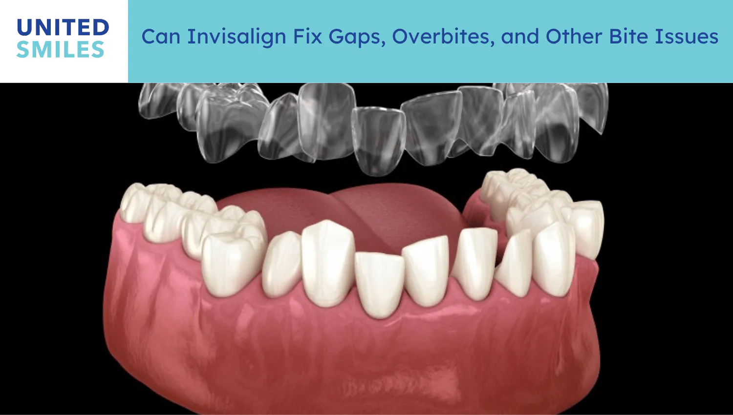 3D model of spaced lower teeth with a clear aligner, illustrating how Invisalign closes gaps
