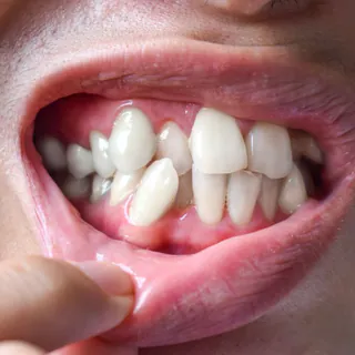 Close-up of a mouth with a gap between the front teeth and crowded lower teeth