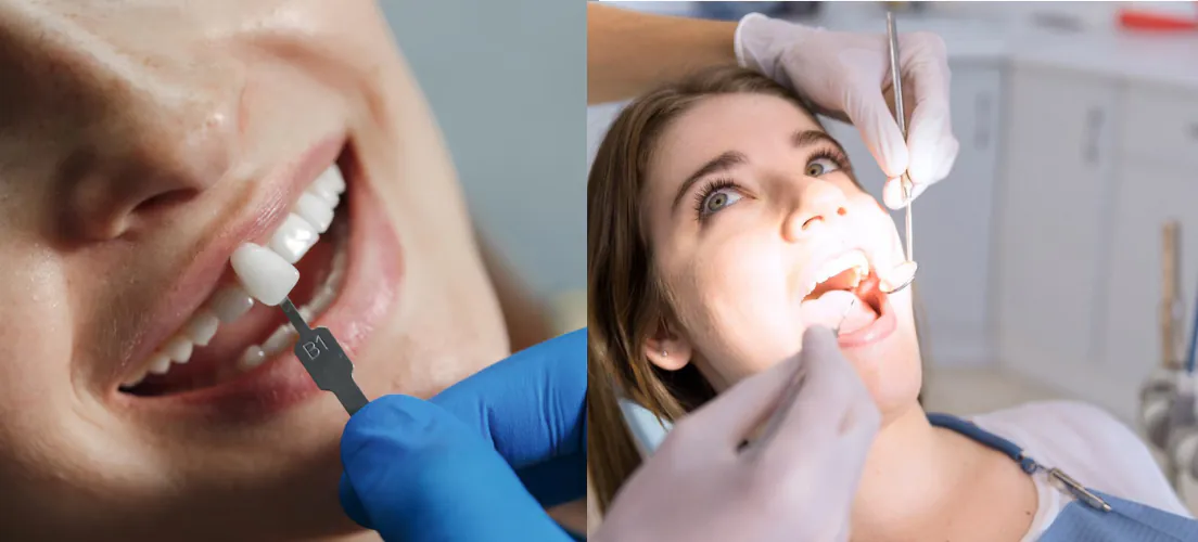 Shade matching and treatment for a dental crown or filling