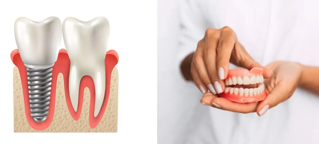 A dental implant fixed in the jawbone beside a removable full denture held in a hand