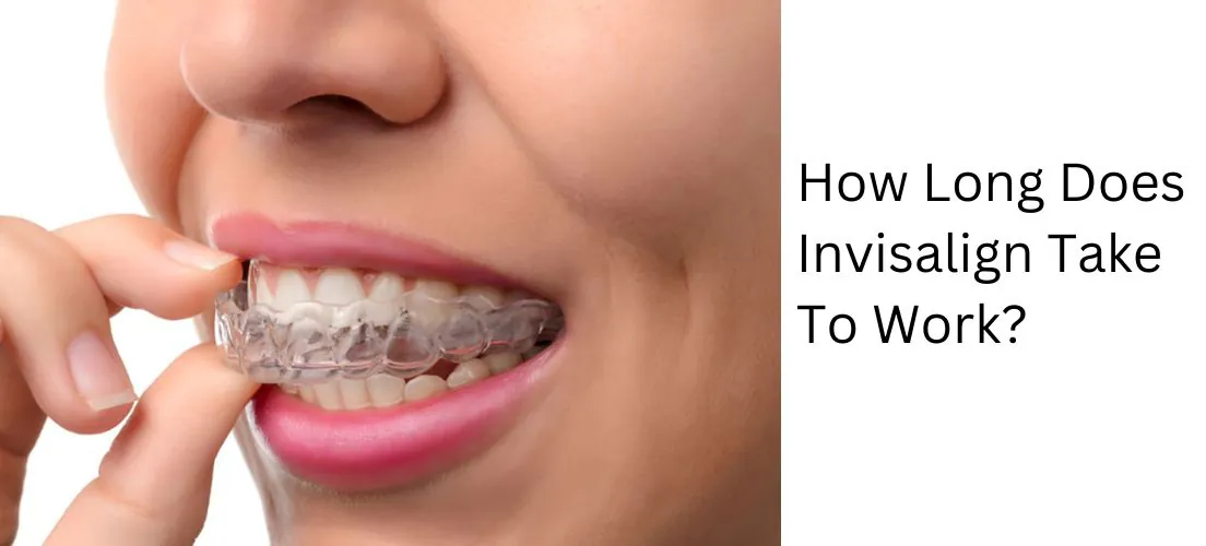 Woman fitting a clear Invisalign aligner over her teeth