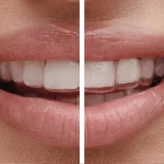 Before-and-after comparison of a crooked smile and a straightened smile