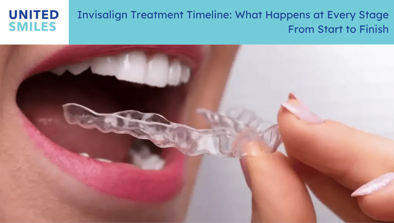 Woman inserting a clear aligner, illustrating the Invisalign treatment timeline