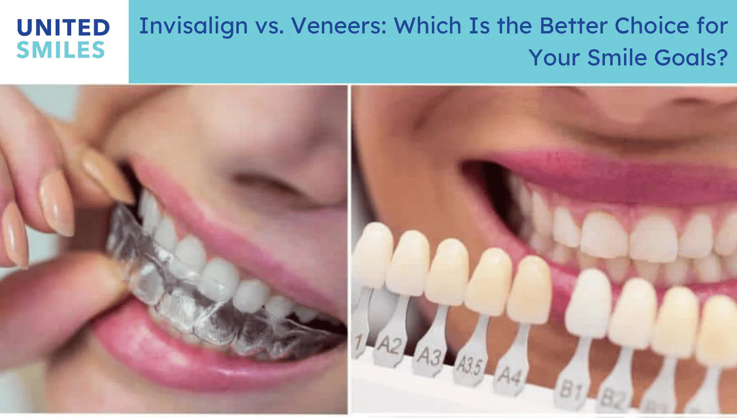 'Invisalign versus veneers' comparison with a clear aligner and veneer shade guide