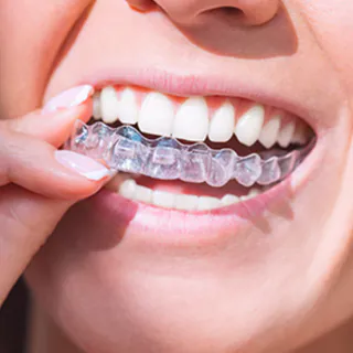Close-up of a woman placing a clear aligner over her teeth