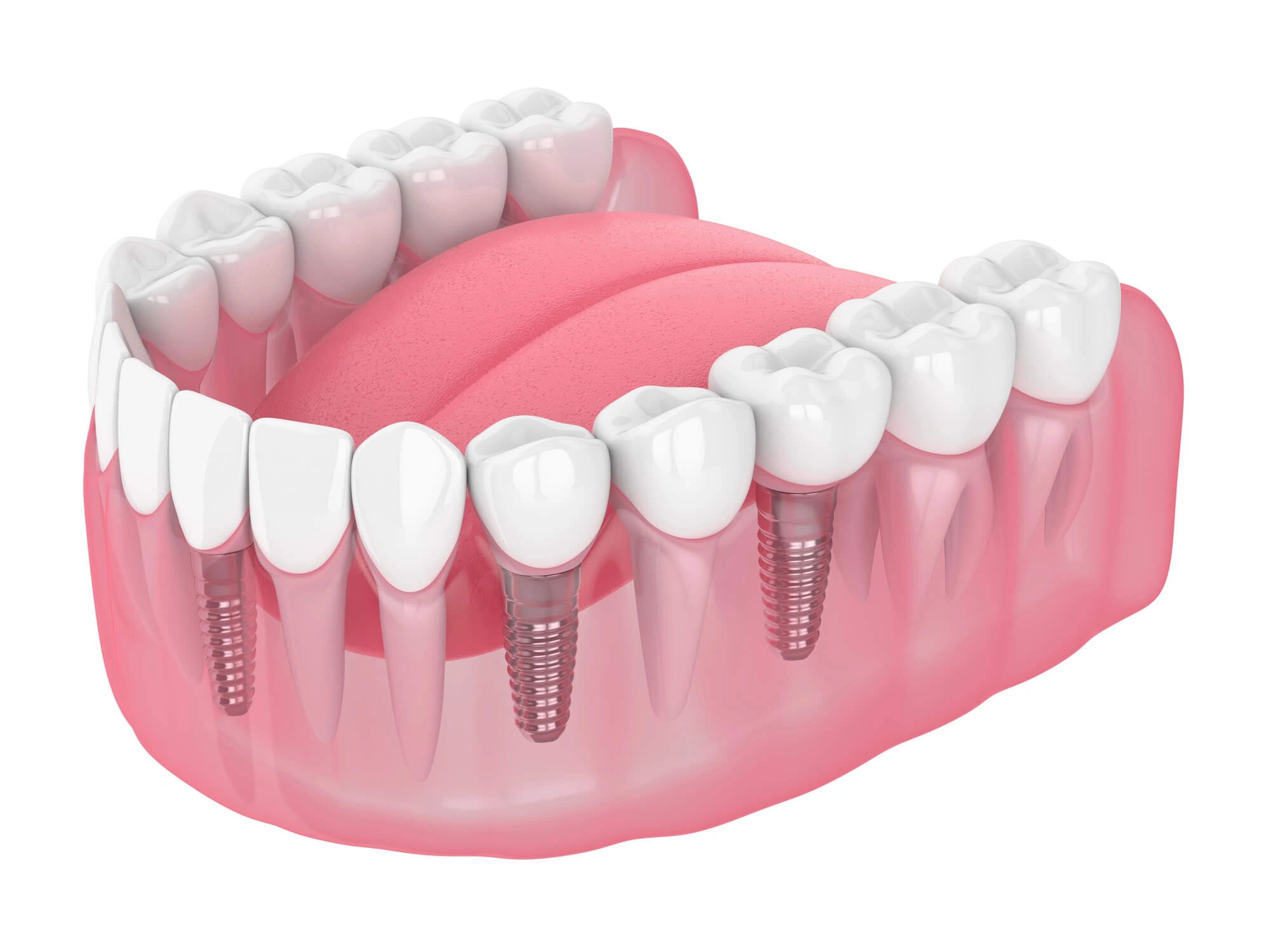 3D image of dental implants levittown