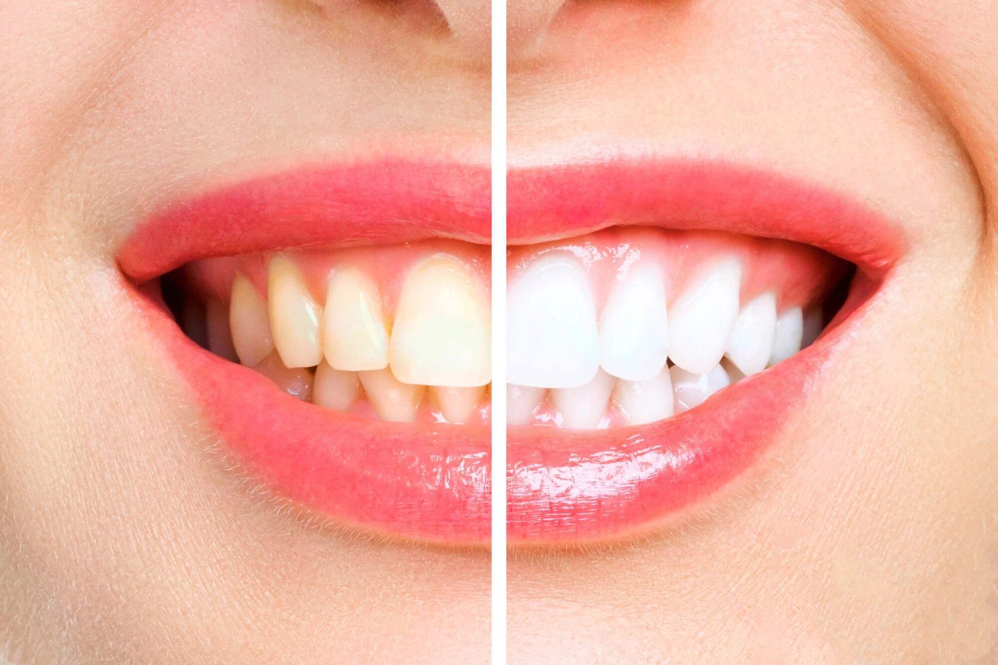 Before and after levittown teeth whitening