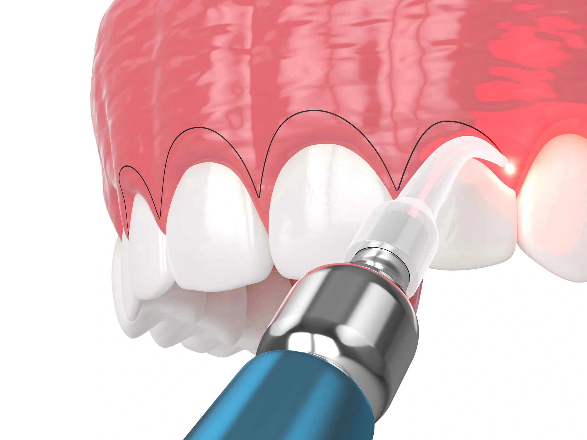 3D illustration of gum contouring by dentist levittown ny