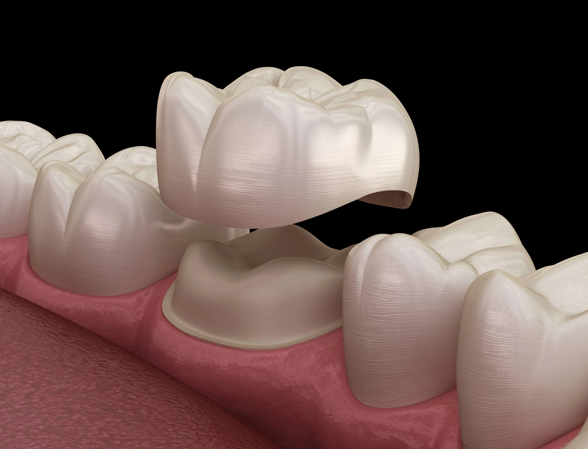 3D illustration of crowns by restorative dentist levittown