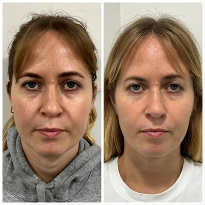 polynucleotides and dermal fillers before after