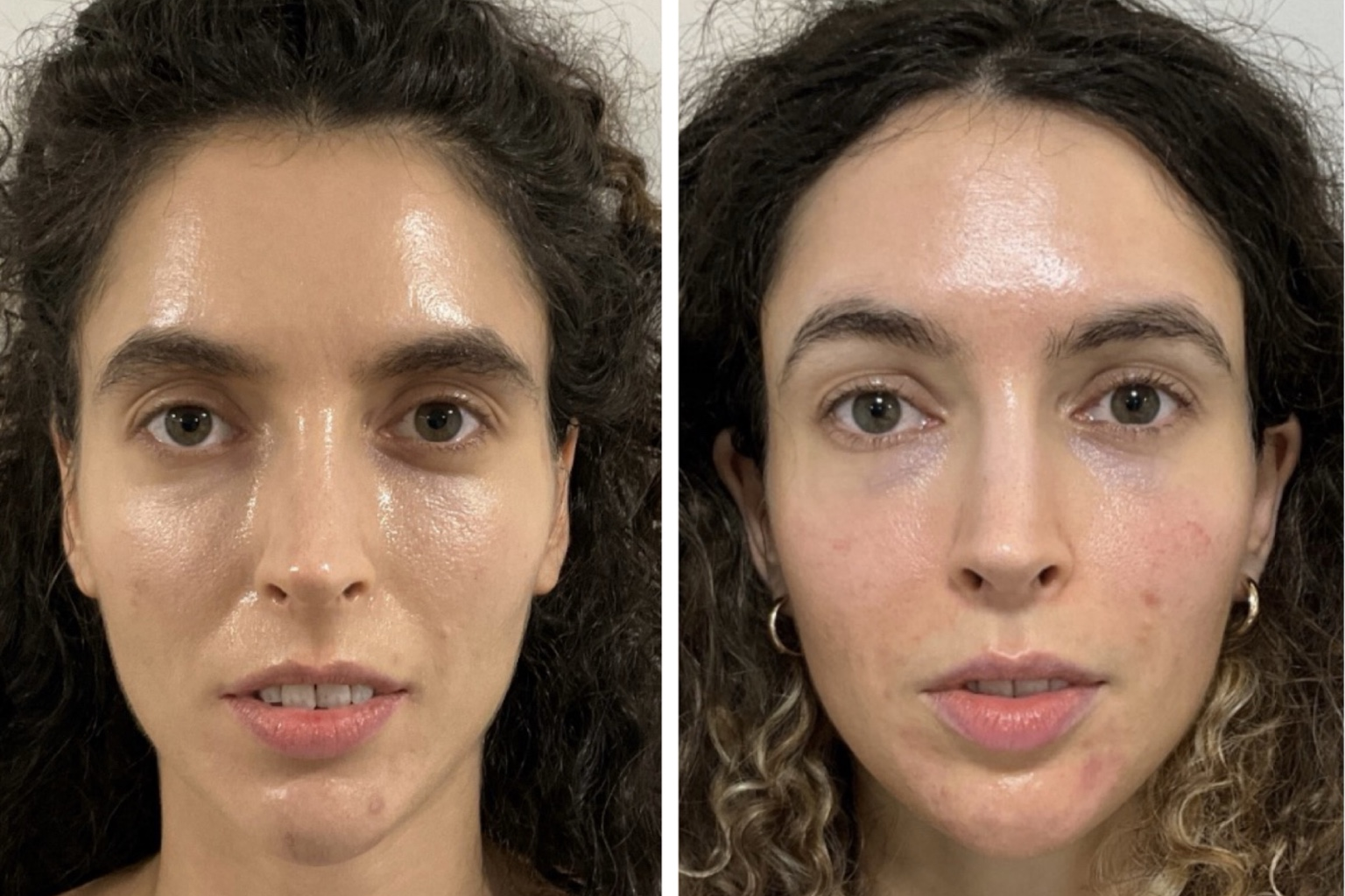 sculptra-treatment-beforeand-after-woman-face