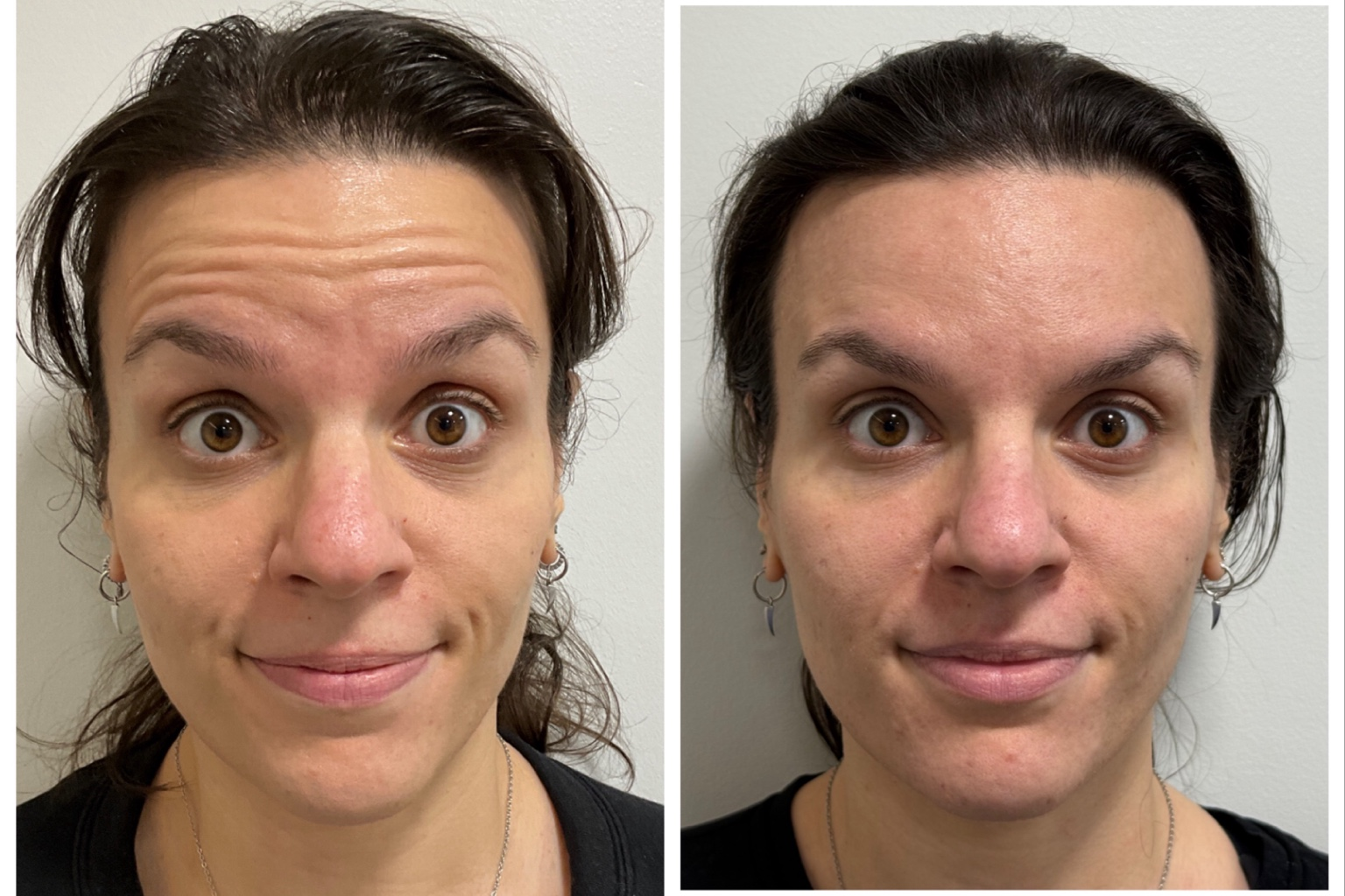 Anti-Wrinkle-Injections-before-andafter-woman-face