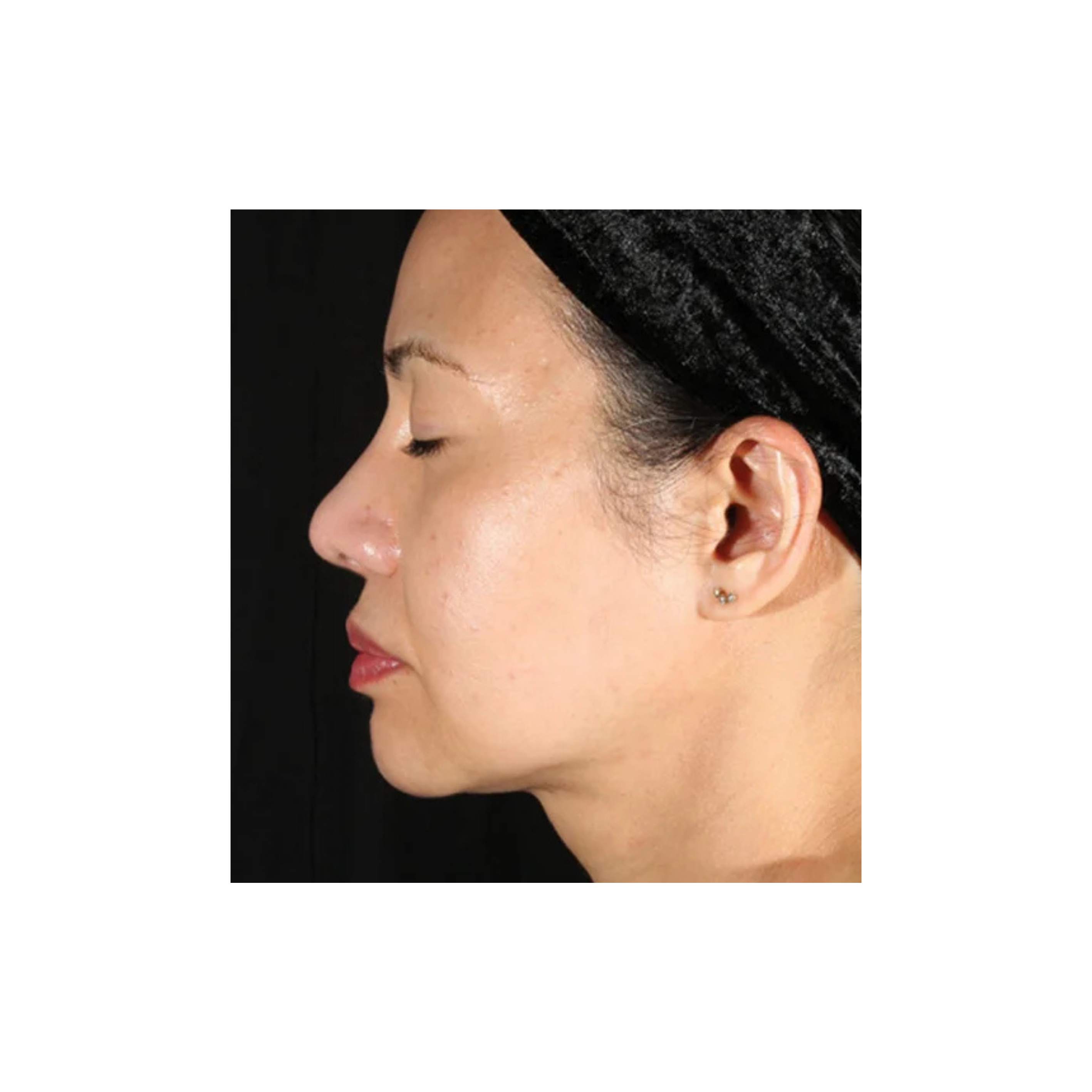 before and after Botox/Dysport treatments in Mentor Ohio