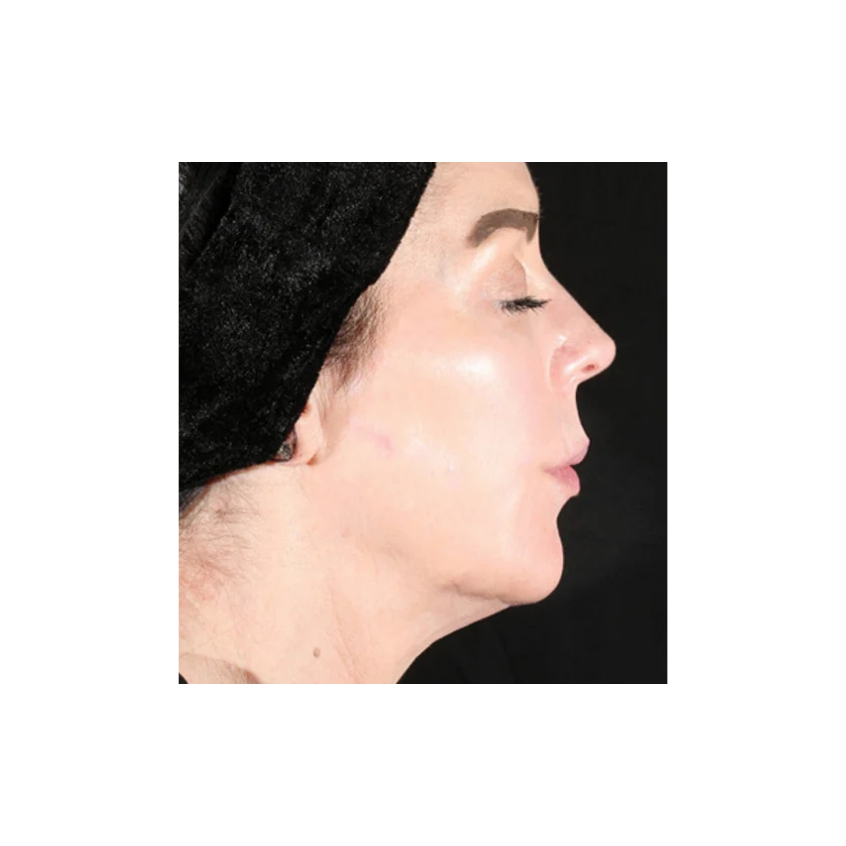 before and after Botox/Dysport treatments in Mentor Ohio