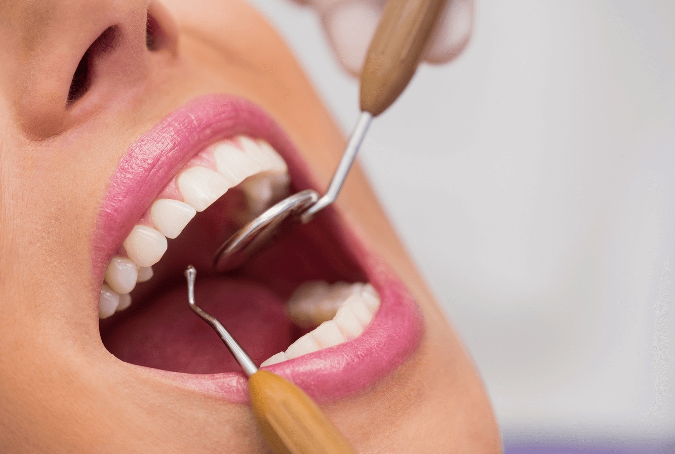 Close-up of a woman’s mouth during a dental exam at the best dentist in Naperville for a root canal